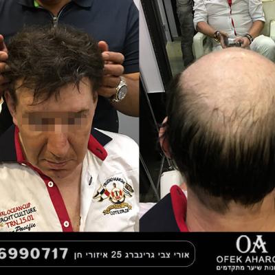 תוספות שיער למילוי שיער אצל גברים